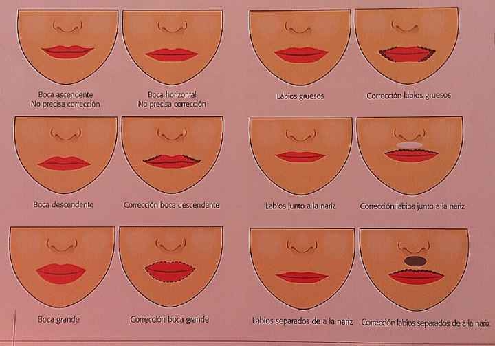 correcciones labios