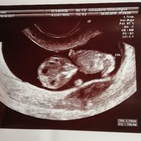 Ayuda con método ramzi: niño o niña? - 1