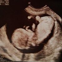 Ayuda con método ramzi: niño o niña? - 1