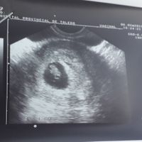 Ayuda con método ramzi: niño o niña? - 1