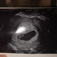 Ayuda con método ramzi: niño o niña? - 1