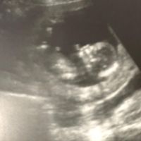 Ayuda con método ramzi: niño o niña? - 2