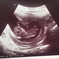 Ayuda con método ramzi: niño o niña? - 1