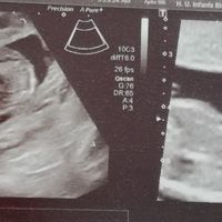 Ayuda con método ramzi: niño o niña? - 1