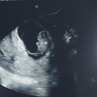Ayuda con método ramzi: niño o niña? - 1