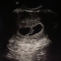 Semana 6 vaginal
