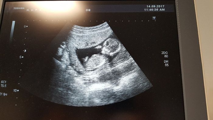  Niño o niña?? - 2