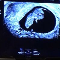 Ayuda con método ramzi: niño o niña? - 1