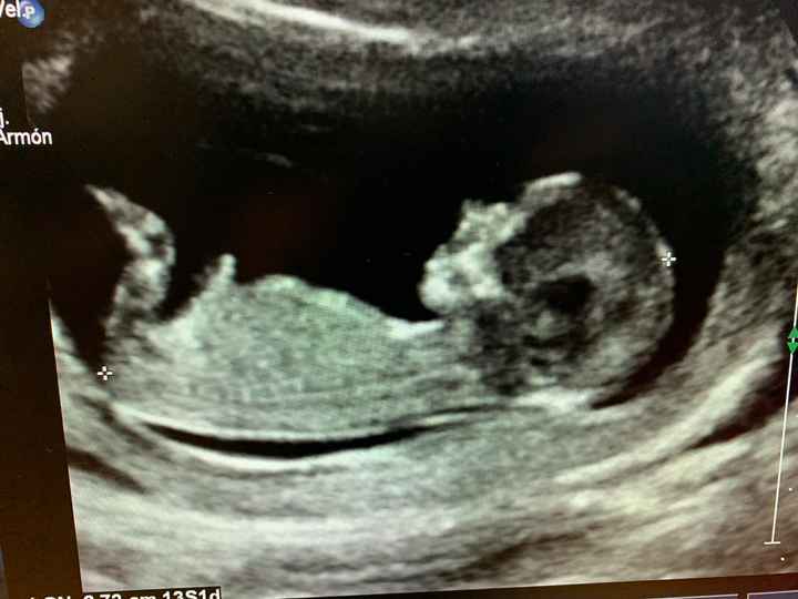 Ayuda con método ramzi: niño o niña? - 1