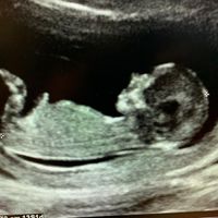Ayuda con método ramzi: niño o niña? - 1