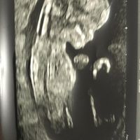 Ayuda con método ramzi: niño o niña? - 2