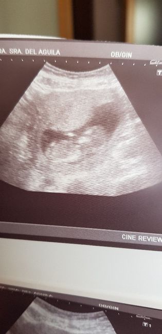 Ayuda con método ramzi: niño o niña? 5