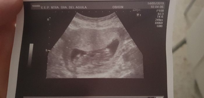 Ayuda con método ramzi: niño o niña? 11