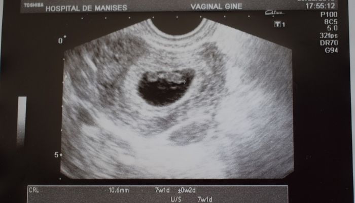 eco 7 semanas vaginal
