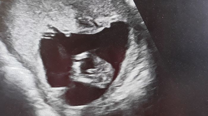 Ayuda con método ramzi: niño o niña? 8