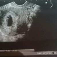 Ayuda con método ramzi: niño o niña? - 1