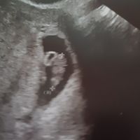 Ayuda con método ramzi: niño o niña? - 1