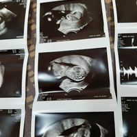 Ayuda con método ramzi: niño o niña? - 1