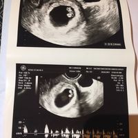 Ayuda con método ramzi: niño o niña? - 1