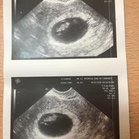 Ayuda con método ramzi: niño o niña? - 1