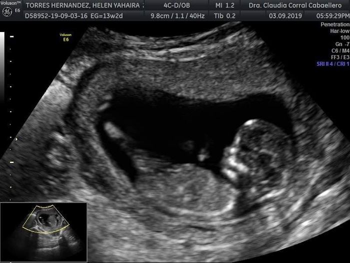 Tubérculo genital: niña - 1
