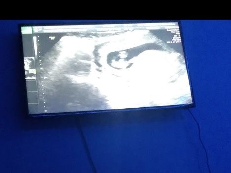 Tubérculo genital: niña - 2