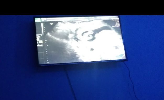 Tubérculo genital: niña - 1