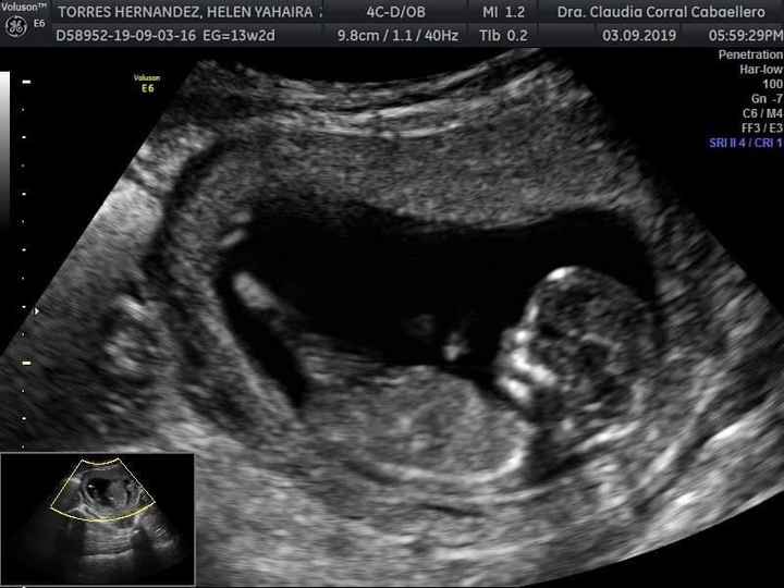 Tubérculo genital: niña 6