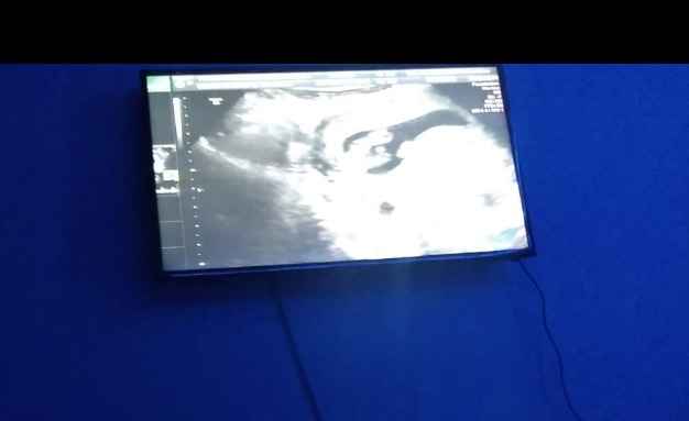 Tubérculo genital: niña 4