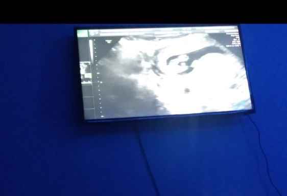 Tubérculo genital: niña 5