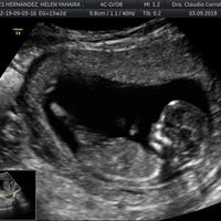 Tubérculo genital: niña - 1