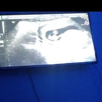 Tubérculo genital: niña - 2