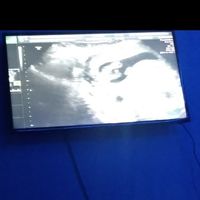 Tubérculo genital: niña - 1