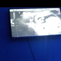 Tubérculo genital: niña - 2