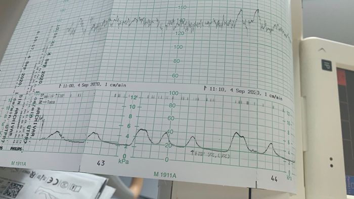 Monitorización fetal - 1