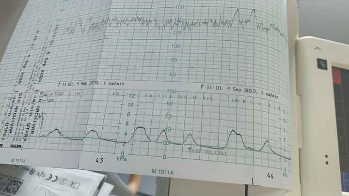Monitorización fetal - 1