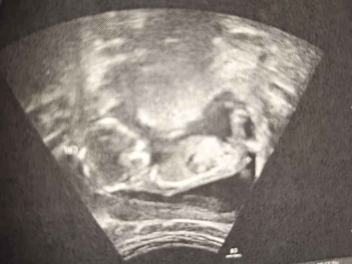 Tubérculo genital niño o niña??? 24