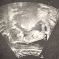 Tubérculo genital niño o niña??? - 1