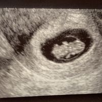 Ayuda con método ramzi: niño o niña? - 1
