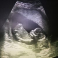 Eco 13 semanas, niño o niña?