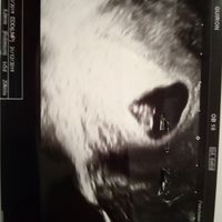 Ayuda con método ramzi: niño o niña? - 1
