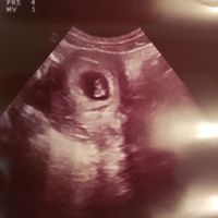 Ayuda con método ramzi: niño o niña? - 1