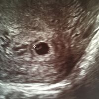 Ayuda con método ramzi: niño o niña? - 1