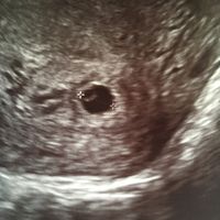 Ayuda con método ramzi: niño o niña? - 2