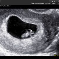 Ayuda con método ramzi: niño o niña? - 1