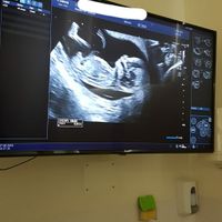 Ayuda con método ramzi: niño o niña? - 1