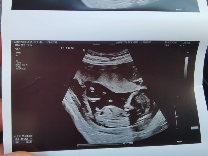 Tubérculo genital: niña - 1