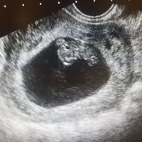 Ayuda con método ramzi: niño o niña? - 1