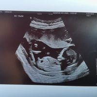 Ayuda con método ramzi: niño o niña? - 1