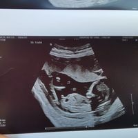 Tubérculo genital: niña - 1